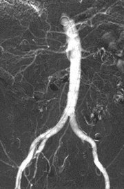 abdomina aorta